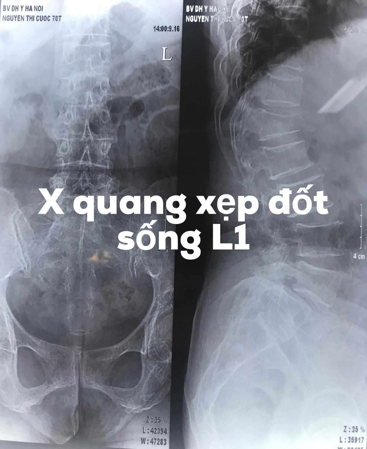 x quang thường quy xẹp đốt sống