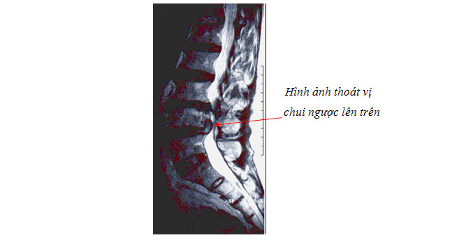 cong-huong-tu-chuan-doan-thoat-vi-dia-dem