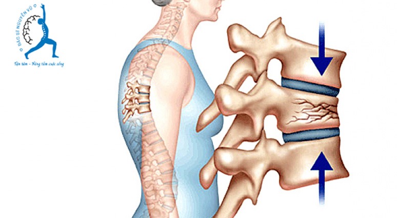 lún xẹp đốt sống